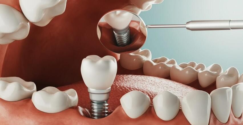 Jak przebiega wszczepienie implantu od kwalifikacji do osadzenia odbudowy