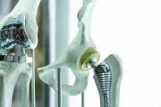 Implanty stomatologiczne – Viscardi Piotr Nzoz Praktyka Stomatologiczna